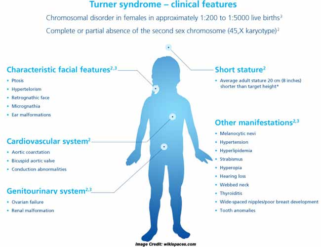 Who Can Get Turner Syndrome And How To Deal With It
