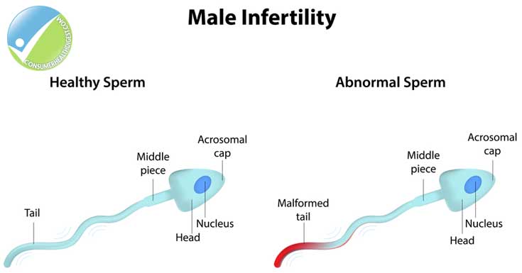 Prostatitis unidox