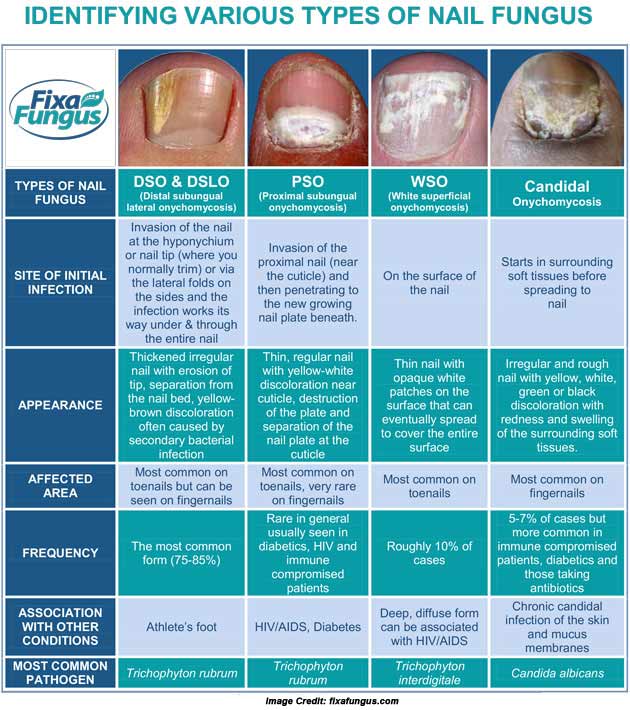 Nail Fungus