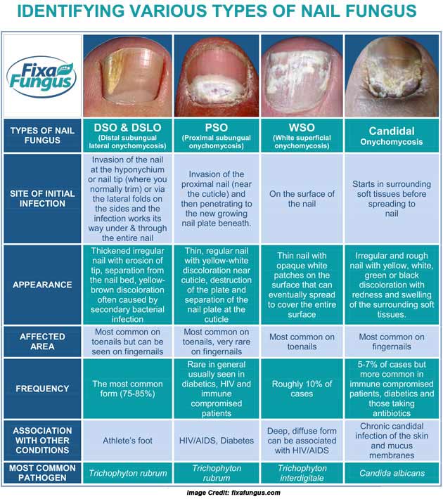 Collection 97+ Wallpaper Types Of Nail Diseases With Pictures Updated ...