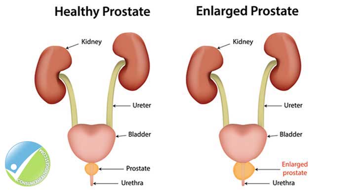 Enlargement Prostate