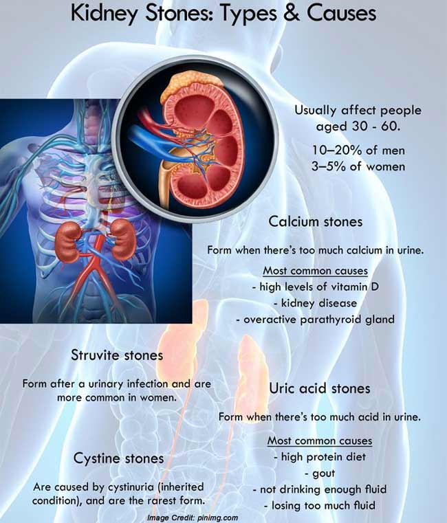 30 Minute Can workout supplements cause kidney stones for Fat Body