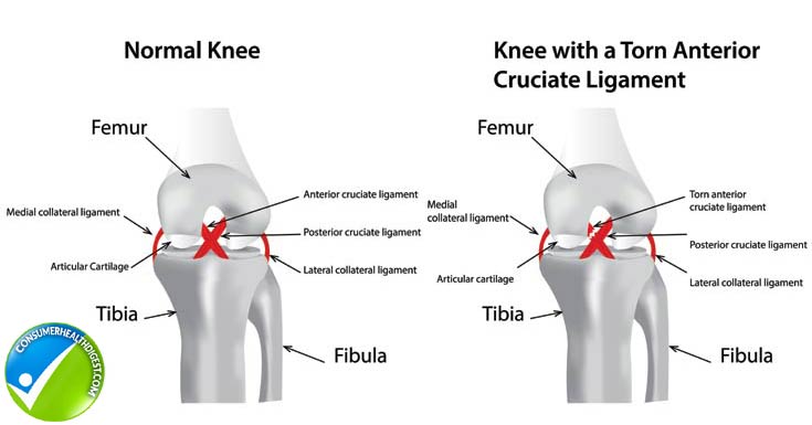 ACL injury