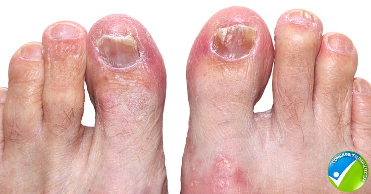 Athletes Foot Symptoms