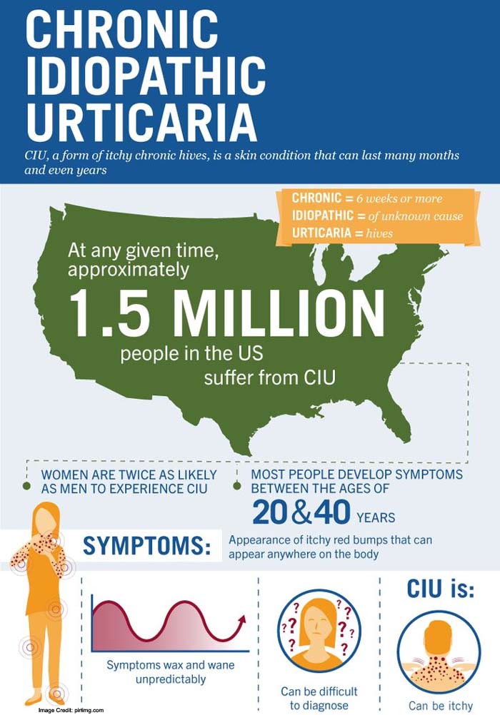 Urticaria Info