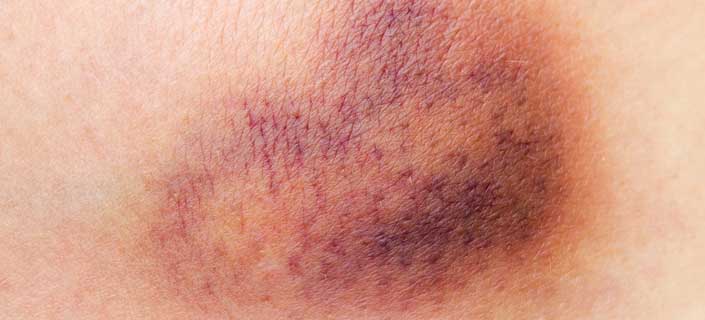 Bruising Often? 10 Interesting Facts You Must Know About Bruises