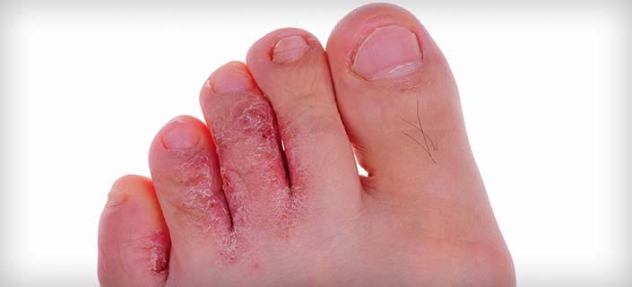 What is Athlete's Foot and How to Prevent it?