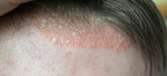 Seborrheic Dermatitis: Causes, Symptoms, and Treatments