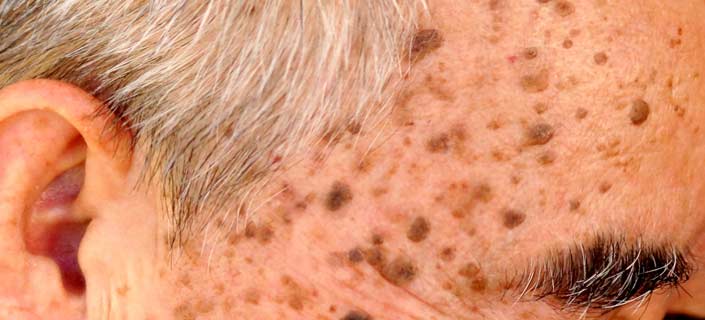 What Is Seborrheic Keratosis & How Is It Caused & Diagnosed?