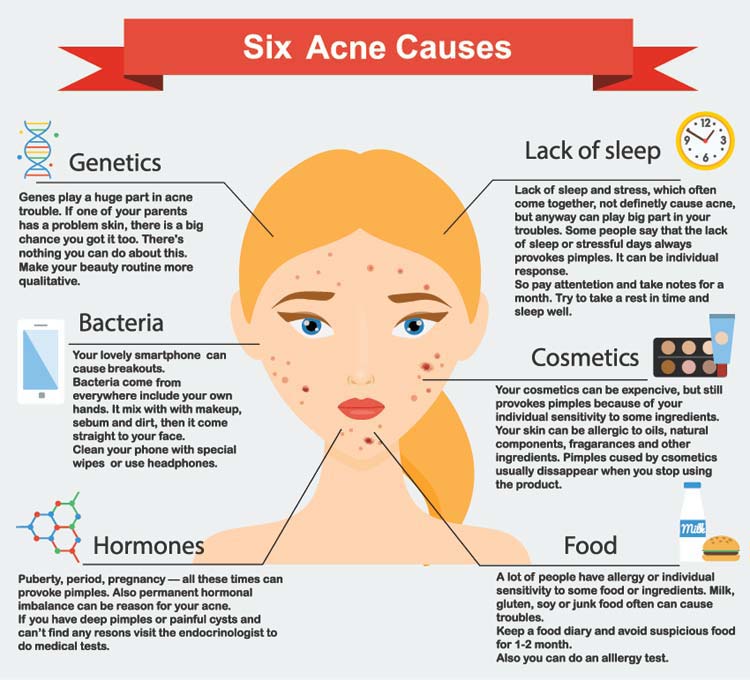 Acne Causes Info