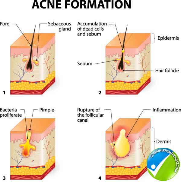Acne Signs and Symptoms