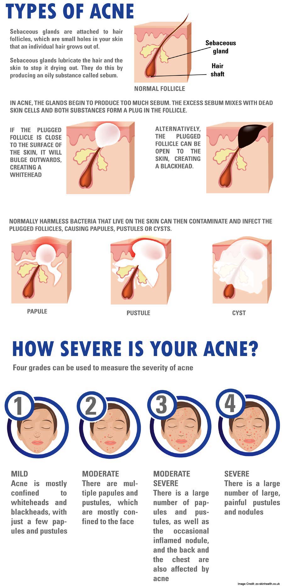 Avne Types Info