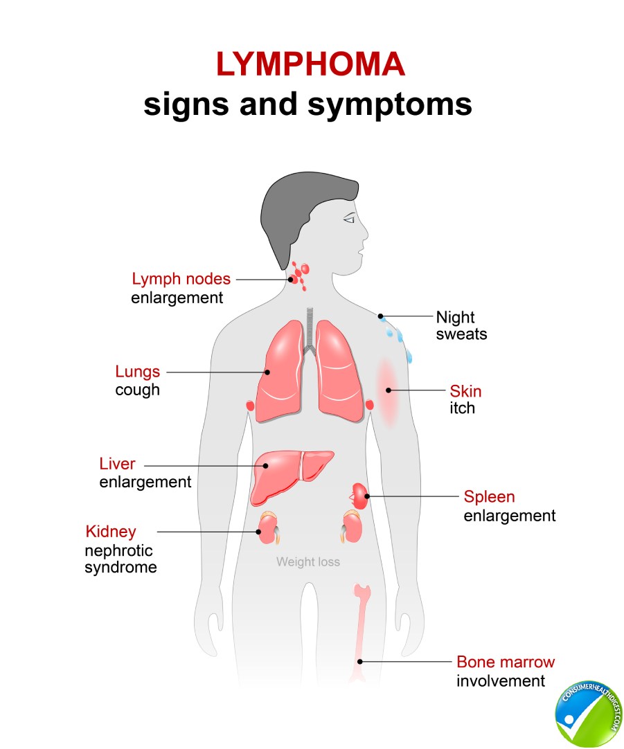 Lymphoma Symptoms Causes And How Bad Is Lymphoma Cancer