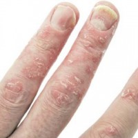 How To Prevent Psoriasis