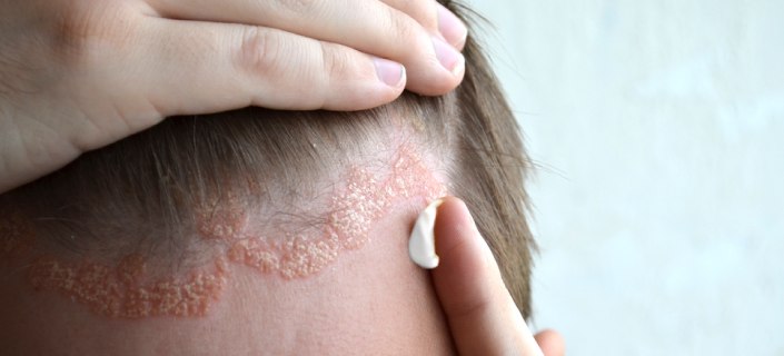 Psoriasis skin disease treatment in urdu