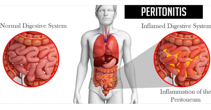 Peritonitis Ruptured Appendix