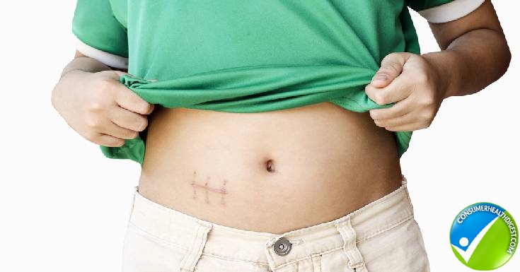 Recovering From An Appendectomy