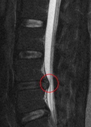 Lumbar Disc Disease