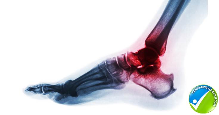 ankle and foot arthritis