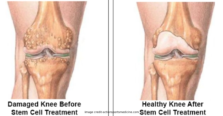 stem cell therapy for knees