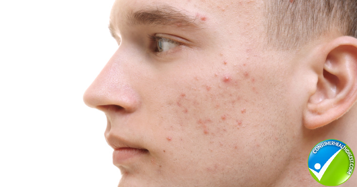 Acne