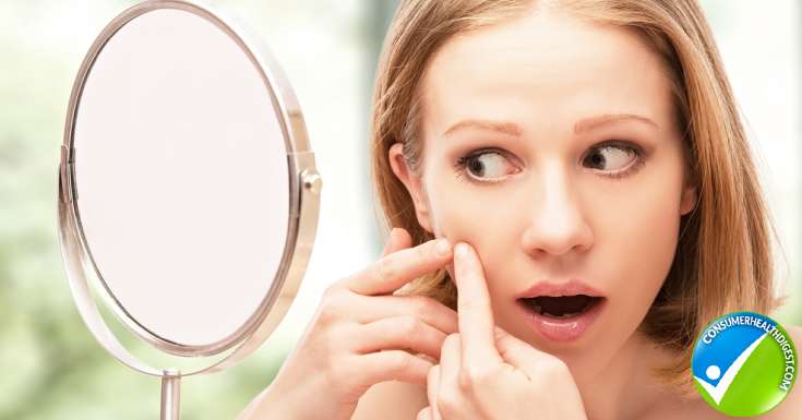 Get Rid Of Acne Naturally