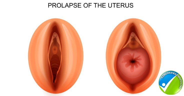 Uterine Prolapse