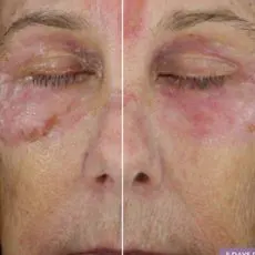 Alastin Restorative Eye Treatment Before and After