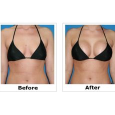 Bustmaxx Before and After