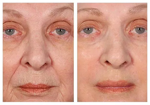 Serious Skincare Insta-Tox antes y después