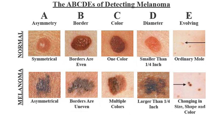 ABCDEs of Melanoma