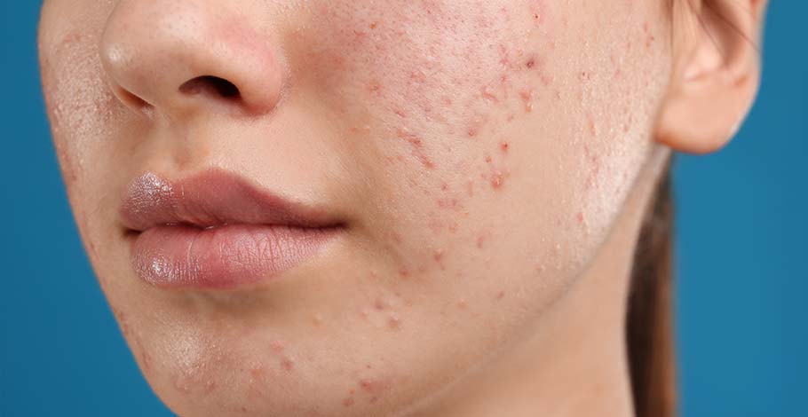 Acne Scars: How To Get Rid Of Acne Scars?