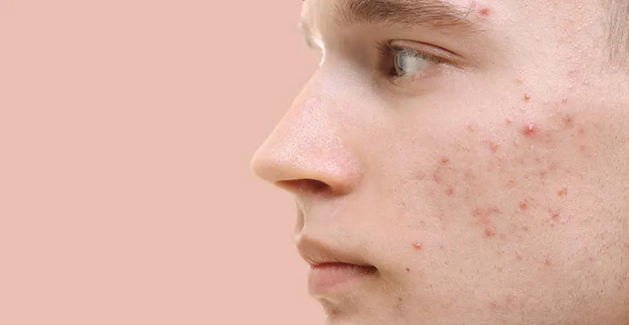 Acne