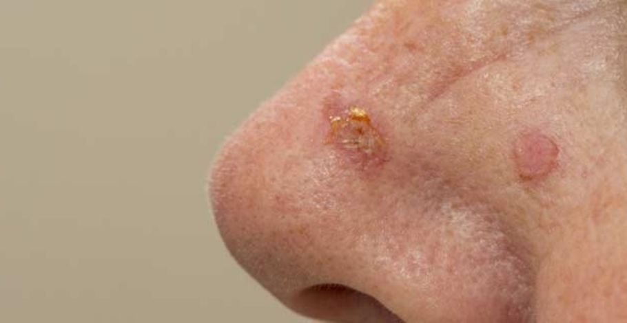 Can Actinic Keratosis Cause Skin Cancer? Find Out