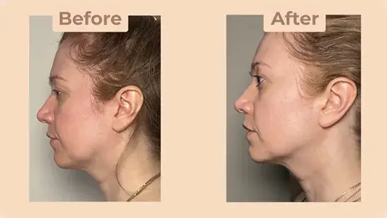 Angellift Dermastrips