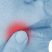 angular-cheilitis