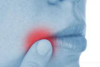 Angular Cheilitis: Causes, Symptoms, Prevention and Treatments