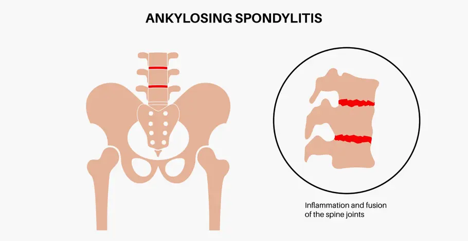 Ankylosing Spondylitis