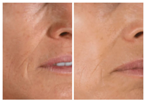 AnteAGE MD Before and After