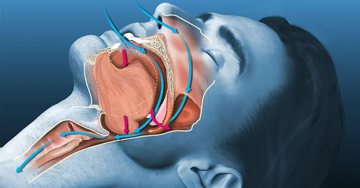 anti snoring devices that work