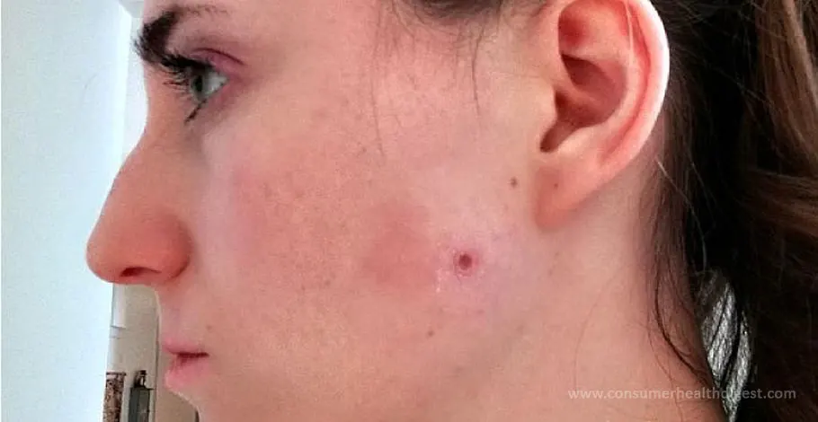 Experience With Acv Removal