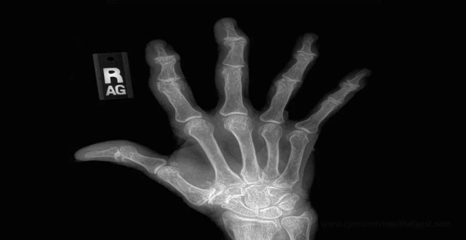 arthritis in hands
