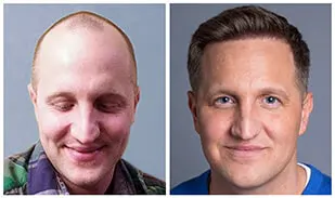 Bosley Before and After