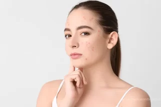 Causes of Acne: Understanding the Root of the Problem