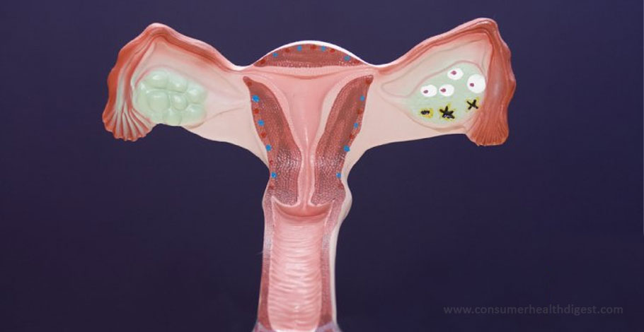 Causes of Vaginal Cysts