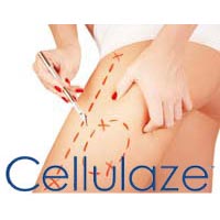Cellulaze Treatment
