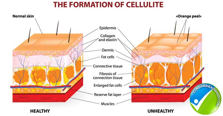 cellulite formation