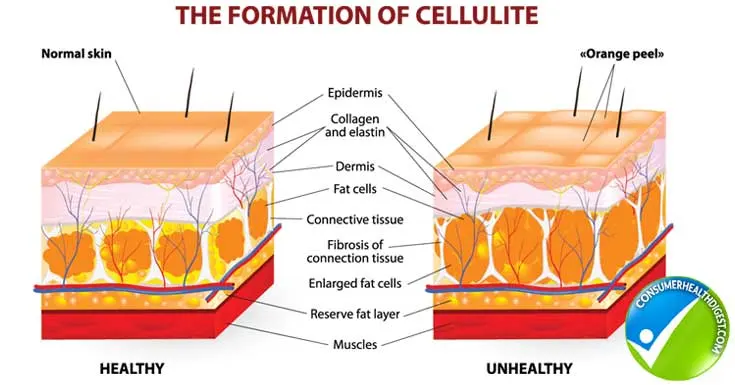 cellulite-formation
