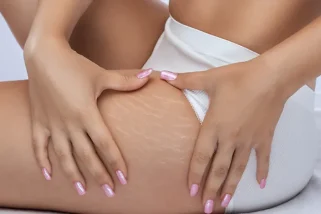 How to Get Rid of Cellulite on Thighs