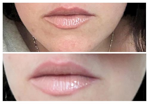 City Lips Reviews Before and After Pictures